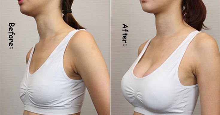 Breast Augmentation